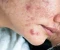 صورة مقال Acne: Causes, Symptoms, Treatment, and Prevention.
