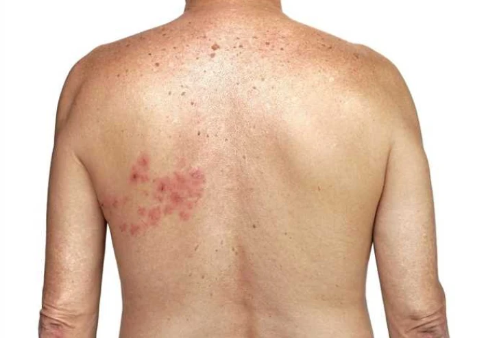 Shingles: A hidden pain that may haunt you after childhood chickenpox
