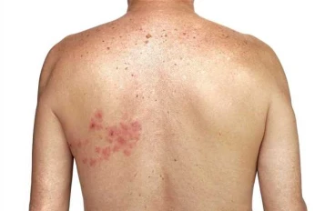 الحزام الناري النطاقي: ألم خفي قد يلاحقك بعد جدري الطفولة