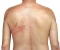 article image for Shingles: A hidden pain that may haunt you after childhood chickenpox