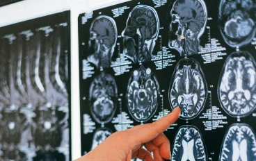 السكتة الدماغية أسبابها وأعراضها وطرق الوقاية 