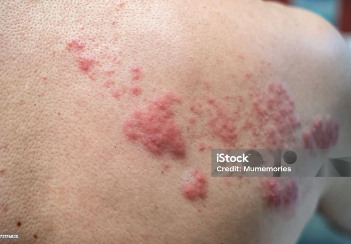 الحزام النارى:اسبابه واعراضه وطرق العلاج منه