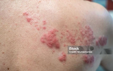 الحزام النارى:اسبابه واعراضه وطرق العلاج منه