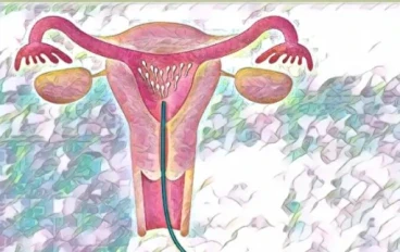  التلقيح الصناعي بطريقة الغربلة 