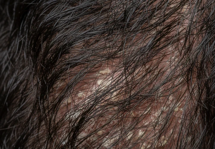 وداعا القشره :دليلك للتخلص من قشره الشعر نهائيا