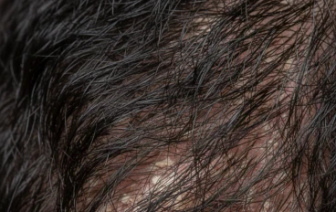  وداعا القشره :دليلك للتخلص من قشره الشعر نهائيا