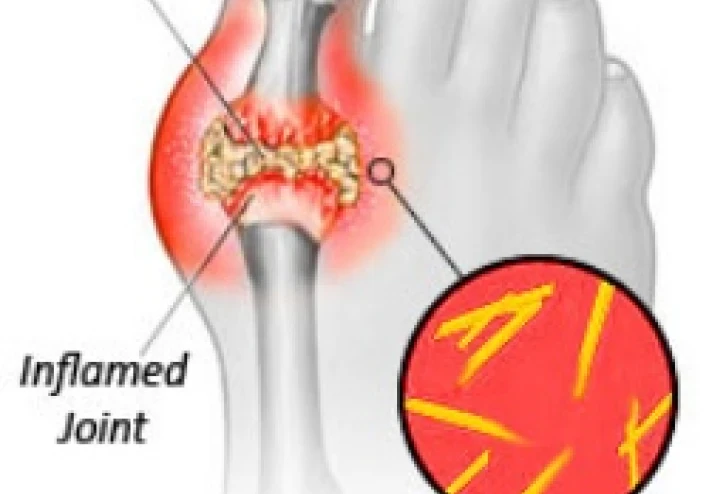 النقرس (داء الملوك): عندما يحتوي دمك على أشواك... وكيف توقف هذه المعاناة؟