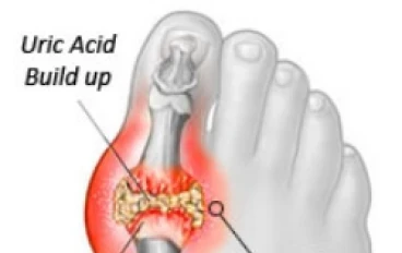 النقرس (داء الملوك): عندما يحتوي دمك على أشواك... وكيف توقف هذه المعاناة؟