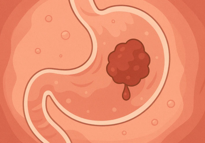 الكشف المبكر عن سرطان القولون