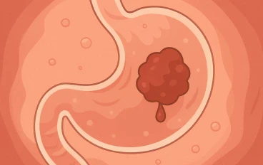 الكشف المبكر عن سرطان القولون