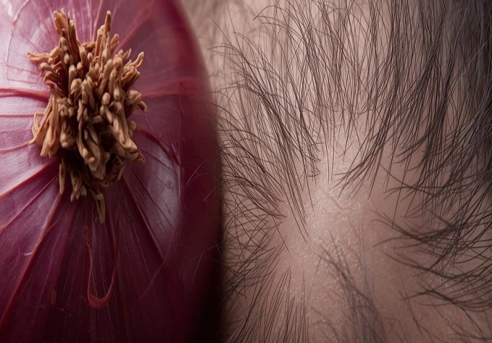 علاج البصل السحري: نمو شعر كثيف وصحي في 6 أسابيع (مجرب ومثبت علميًا)