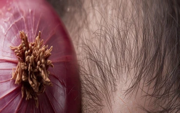 علاج البصل السحري: نمو شعر كثيف وصحي في 6 أسابيع (مجرب ومثبت علميًا)