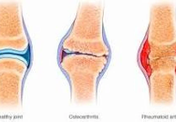 ما هو التهاب المفاصل ؟