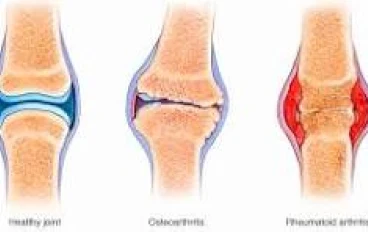 ما هو التهاب المفاصل ؟
