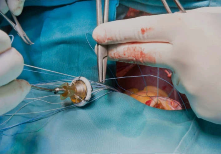 ما بعد  تغيير صمامات القلب - إرشادات هامة