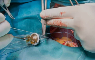  ما بعد  تغيير صمامات القلب - إرشادات هامة