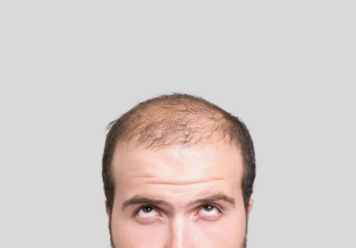 تجارب سريرية تكشف عن فاعلية عالية لعلاج جديد للصلع