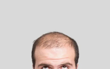 تجارب سريرية تكشف عن فاعلية عالية لعلاج جديد للصلع