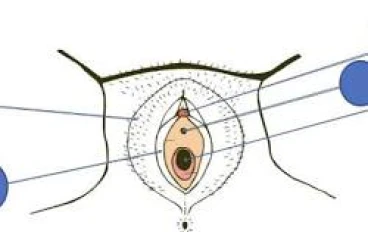 غشاء البكارة بين الحقيقة و الخرافة 