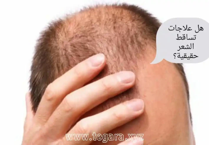 هل علاجات تساقط الشعر مجرد عملية احتيال كبيرة؟