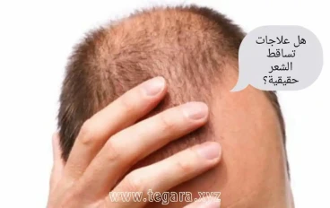 هل علاجات تساقط الشعر مجرد عملية احتيال كبيرة؟