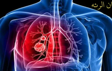 What is lung cancer