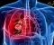What is lung cancer