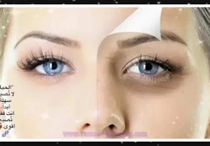 علاج الهالات السوداء تحت العين طبيا