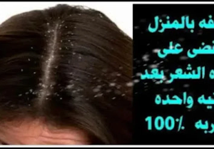 خل التفاح ضد القشرة، لذا افعلوا ذلك