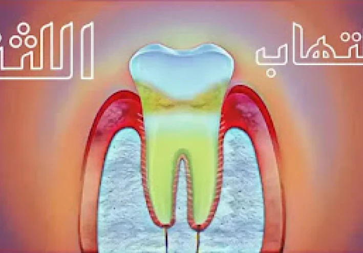 17 طريقة طبيعية لعلاج التهاب اللثة لم تكن تعرفها