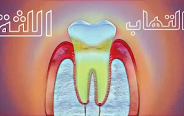 17 طريقة طبيعية لعلاج التهاب اللثة لم تكن تعرفها