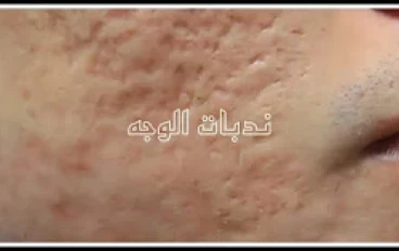 وصفة طبيعية ومذهلة لتجديد البشرة وإزالة الندبات