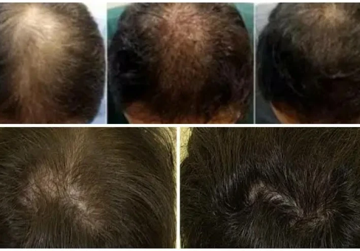 ما هو محلول المينوكسيديل؟ الآثار الجانبية والجرعة والاستخدامات والتحذيرات