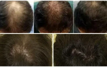 ما هو محلول المينوكسيديل؟ الآثار الجانبية والجرعة والاستخدامات والتحذيرات