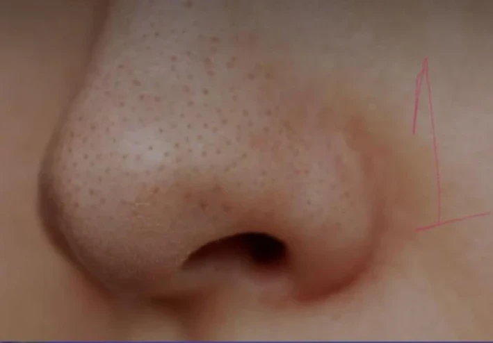 ✔️ إزالة الرؤوس السوداء نهائيًا في البيت: طرق فعالة وآمنة لبشرة صافية بدون تكلفة