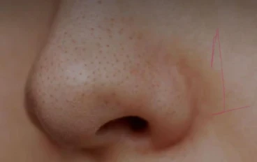 ✔️ إزالة الرؤوس السوداء نهائيًا في البيت: طرق فعالة وآمنة لبشرة صافية بدون تكلفة