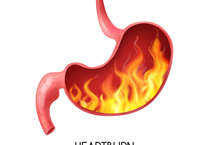 مرض ارتجاع المريء (GERD): الأسباب، الأعراض، وطرق العلاج