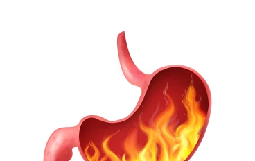 مرض ارتجاع المريء (GERD): الأسباب، الأعراض، وطرق العلاج