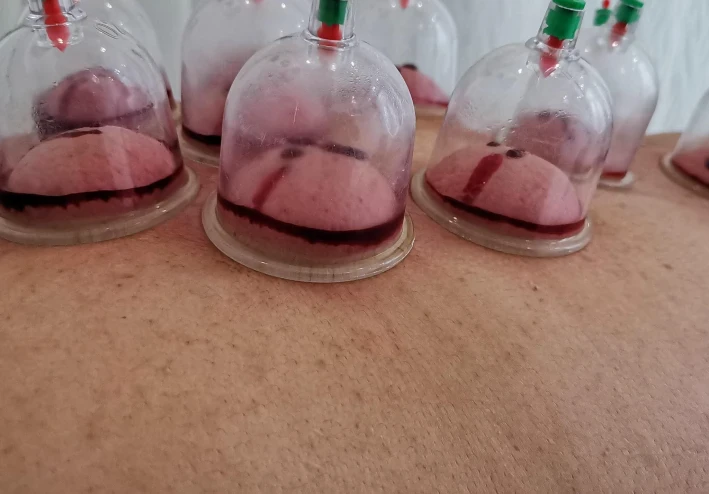 الحجامة العلاجية والوقائية