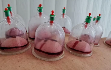 الحجامة العلاجية والوقائية 