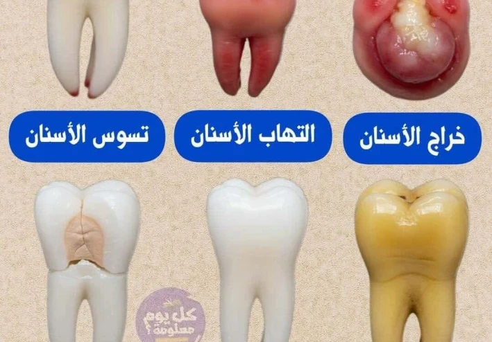 مخاطر أمراض الأسنان وطرق الوقاية منها