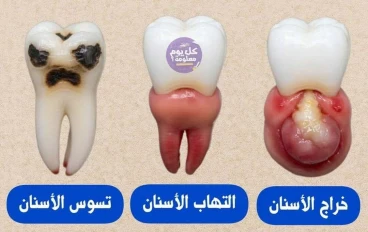 مخاطر أمراض الأسنان وطرق الوقاية منها