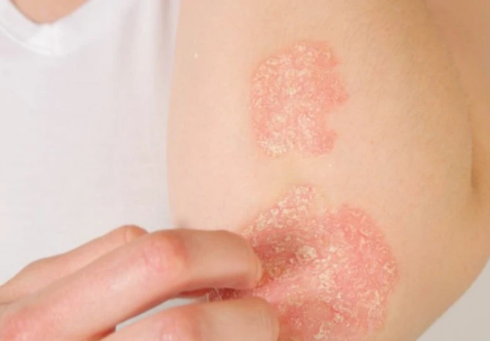 ما لا تعرفه عن الصدفية بالجسم