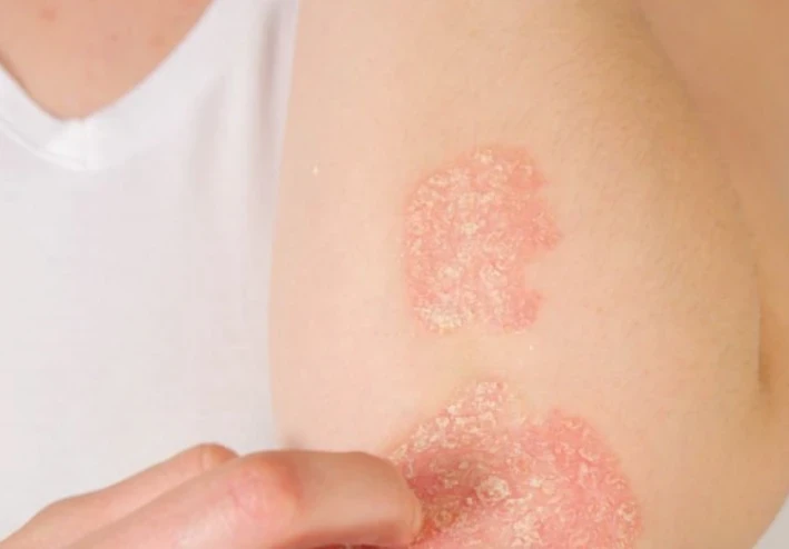 ما لا تعرفه عن الصدفية بالجسم