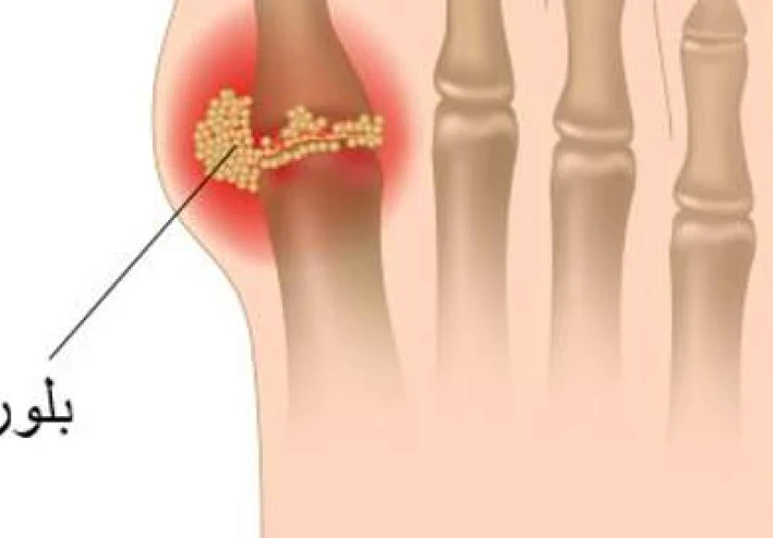 كيفية التعامل مع مرض النقرس: الأسباب، الأعراض، التشخيص، والعلاج والوقاية