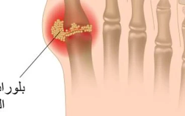 كيفية التعامل مع مرض النقرس: الأسباب، الأعراض، التشخيص، والعلاج والوقاية