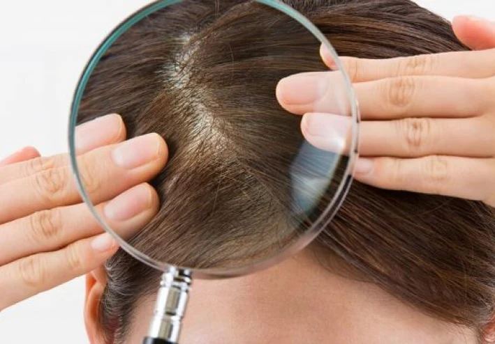 وداعاً للقشرة والزيوت المزعجة: الدليل النهائي لتنظيف الفروة الدهنية وإعادة حيوية شعرك جوجل