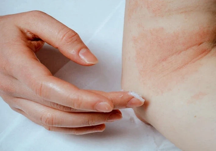 توجد حساسية من البرد وبالتالي يمكنك معرفة ما إذا كنت تعاني منها