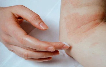 توجد حساسية من البرد وبالتالي يمكنك معرفة ما إذا كنت تعاني منها