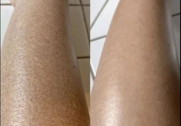 ✴️ كيفية إزالة جلد الوزة بطرق طبيعية وجعل الجلد ناعمًا ولامعًا دائمًا